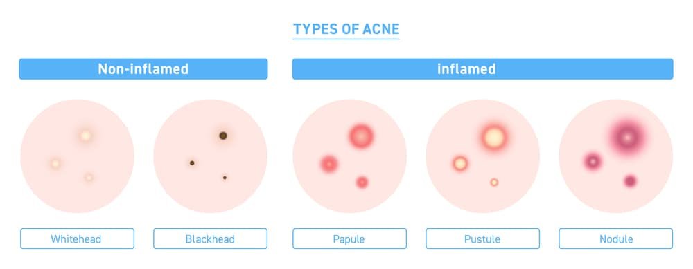 types of acne
