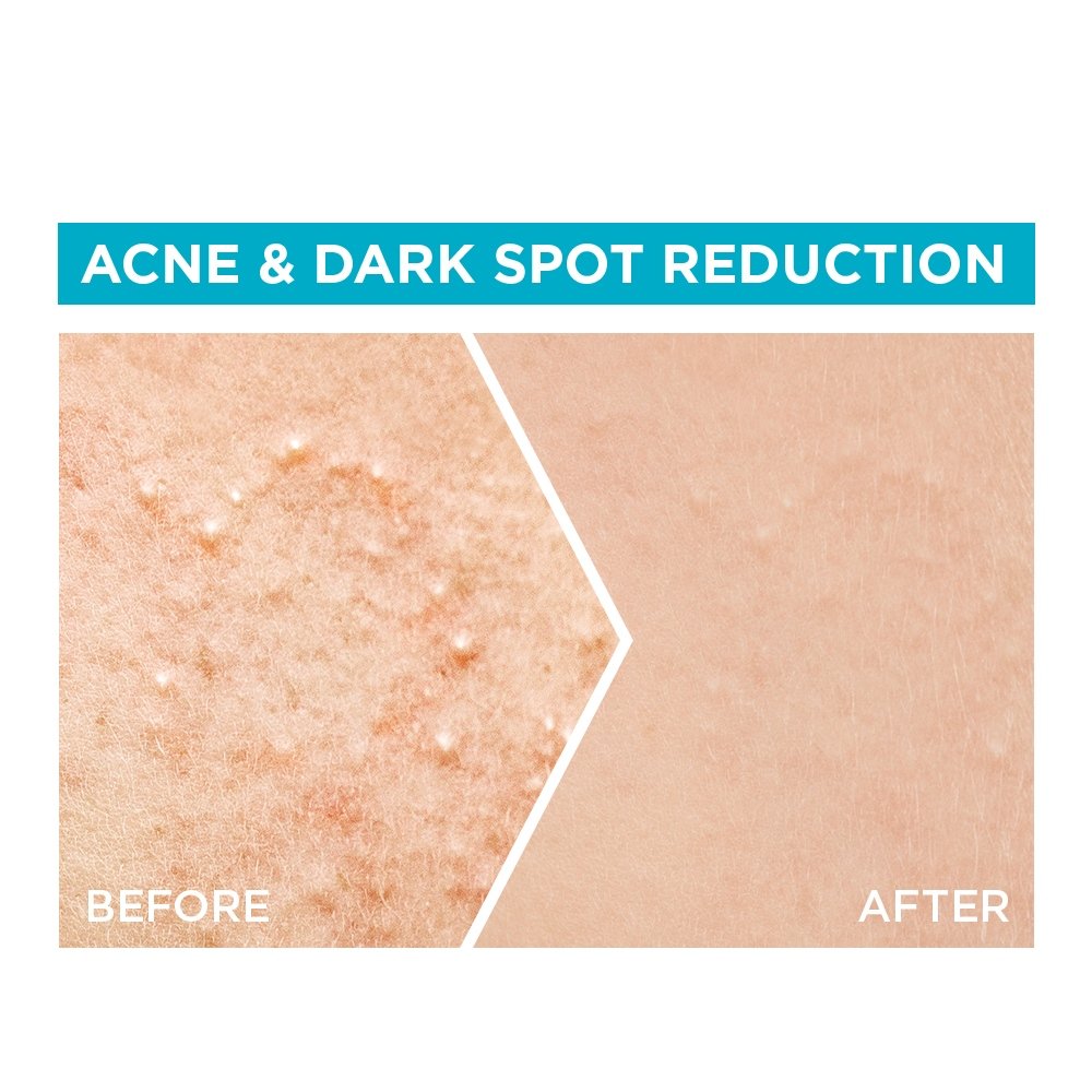 BC Anti-acne Serum