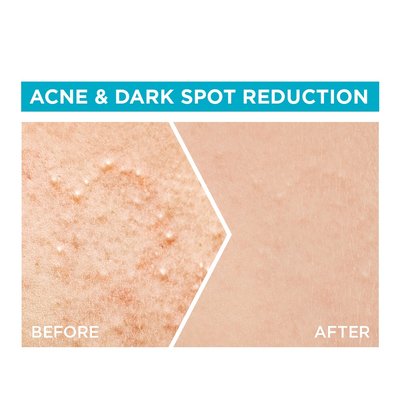 BC Anti-acne Serum